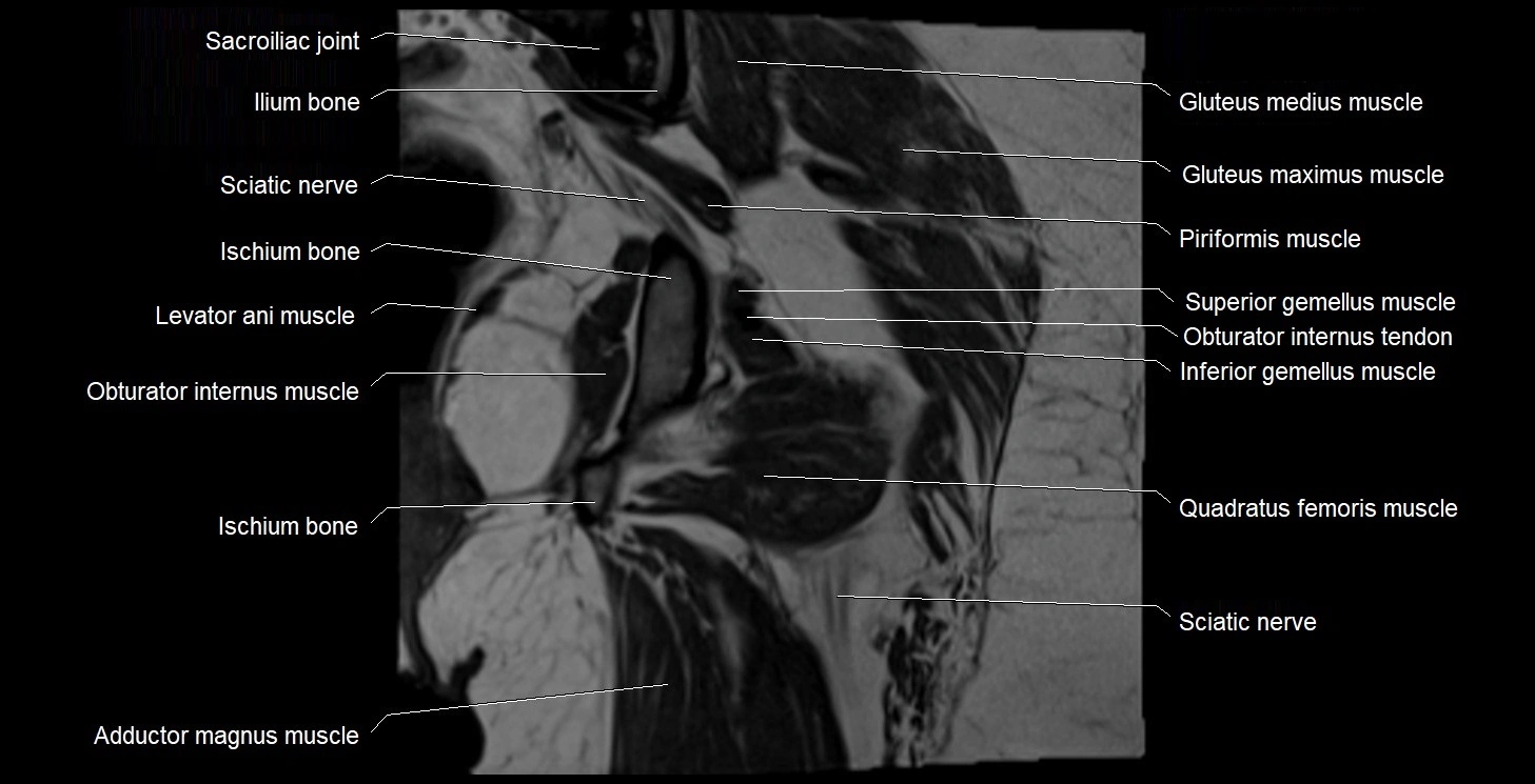MRI Hip 3T coronal cross sectional anatomy image 46.webp